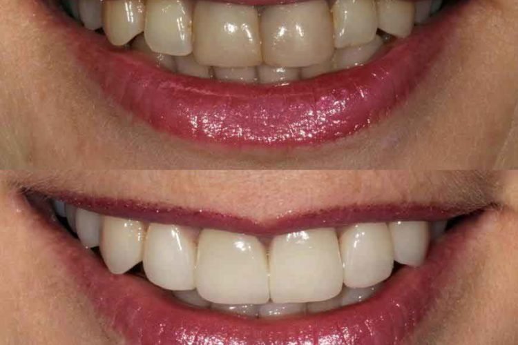 como-mejorar-el-color-de-los-dientes