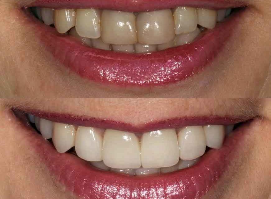 como-mejorar-el-color-de-los-dientes