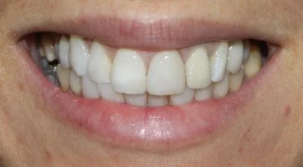 paciente sonriendo con carillas dentales