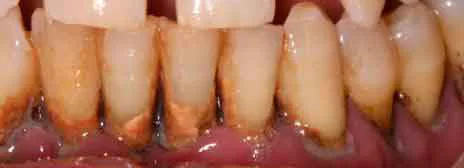 ENFERMEDAD-PERIODONTAL