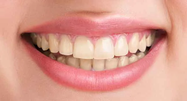 blanqueamiento-dental-preoperatoria