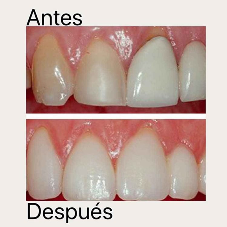 carillas-dentales-mas-coronas-dentales-superiores