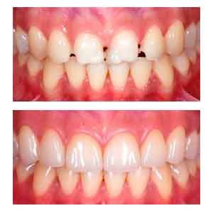 carillas dentales estetica dental -superiores