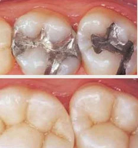 estetica-dental-posterior