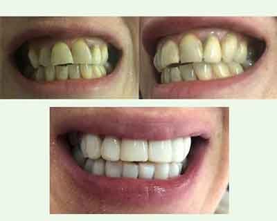 carillas dentales superiores inferiores y de frente