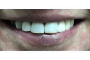 post_-coronas-dentales-esteticas