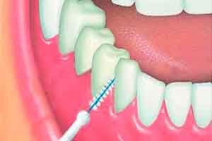 higiene-interdental