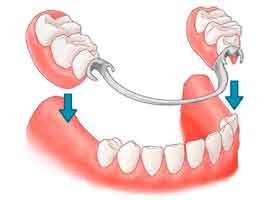 protesis-dental-parcial