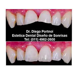 dientes-anteriores-estetica