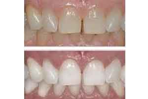 blanqueamiento-dental-como-mejorar-el-color-de-los-dientes