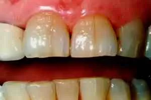 dientes-agrietados-whitesmile