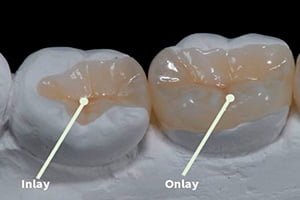 inlay_onlay_dental