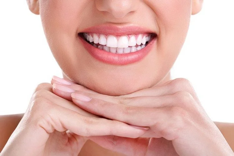 carillas dentales